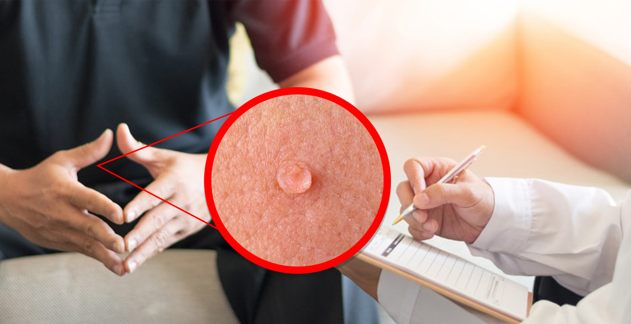 Genital Warts Treatment dubai